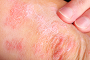 Psoriasis Treatment | Skin Lesion Treatment | Palo Alto CA | Redwood City CA