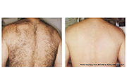 Laser Hair Removal | Laser Resurfacing | Palo Alto CA | Redwood City CA