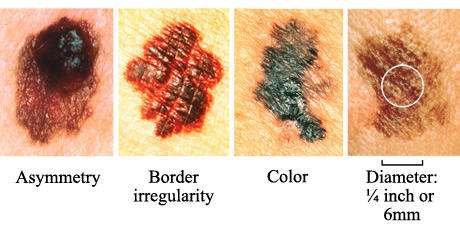 warts on skin or skin cancer)
