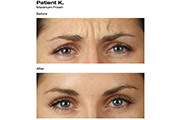 BOTOX® Cosmetic | JUVÉDERM® | Restylane® | Perlane® | Radiesse® | Palo Alto CA | Redwood City CA