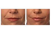 BOTOX® Cosmetic | JUVÉDERM® | Restylane® | Perlane® | Radiesse® | Palo Alto CA | Redwood City CA